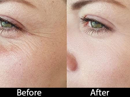 skin-peel after and before